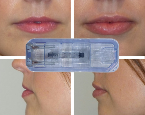CE Injeksi Hyaluronic Acid Filler Lip Injection 24mg/ml