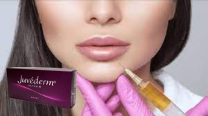 Juvederm Ultra 3 Asam Hyaluronic HA Filler Kulit 2 ml Lip Enhancement