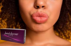 Juvederm Ultra 3 Asam Hyaluronic HA Filler Kulit 2 ml Lip Enhancement