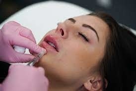GMP Juvederm Ultra 3 HA Filler Kulit Untuk Bibir Juvederm Vollure